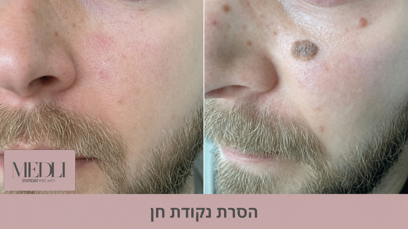 מרפאת מדלי - הסרת נגעים מכל הסוגים מרפאת מדלי - הסרת נגעים מכל הסוגים