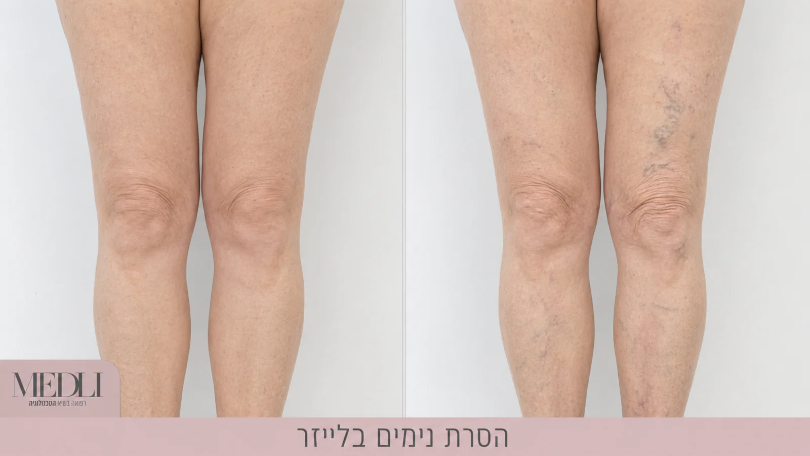 מרפאת מדלי - הסרת קעקועים בלייזר