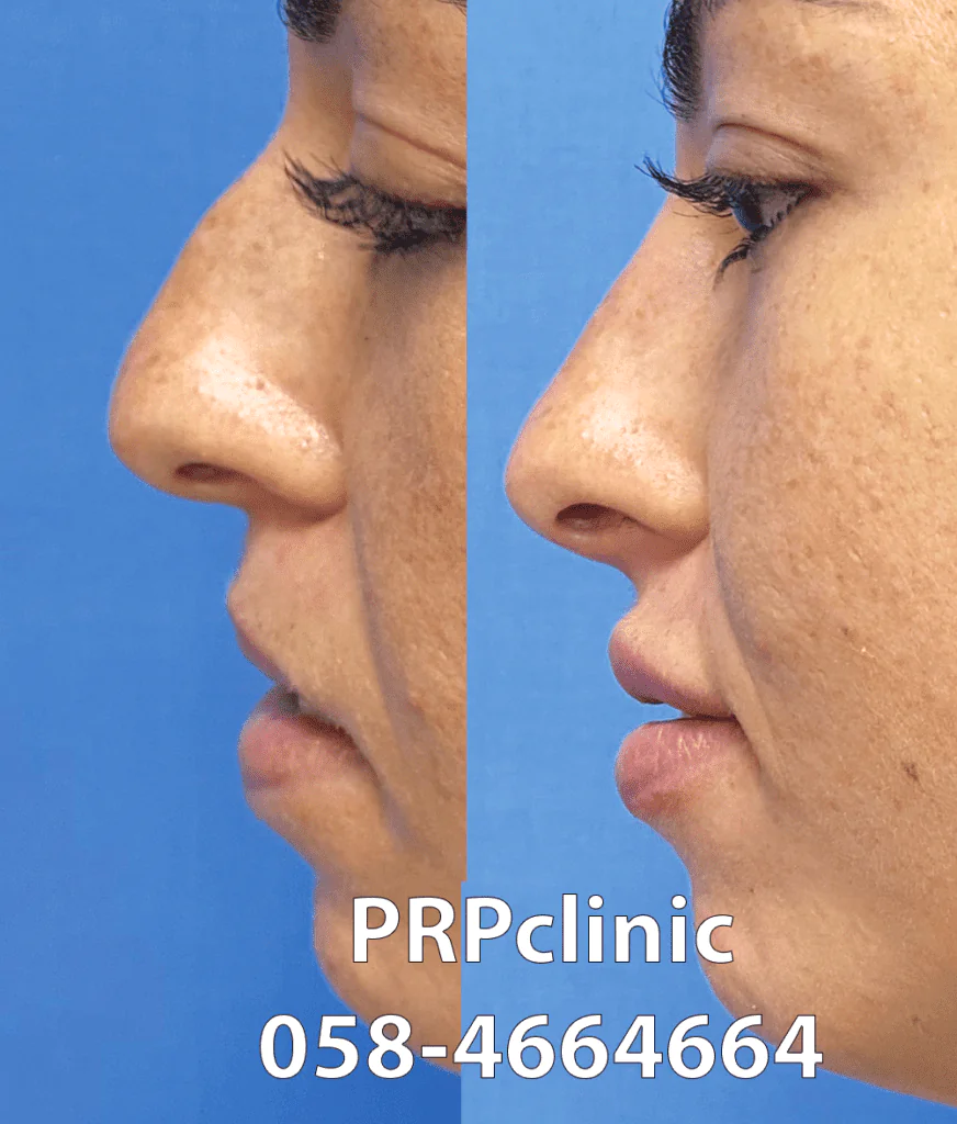 PRP Clinic - עיצוב עצמות לחיים ומילוי לחיים בחומצה היאלורונית