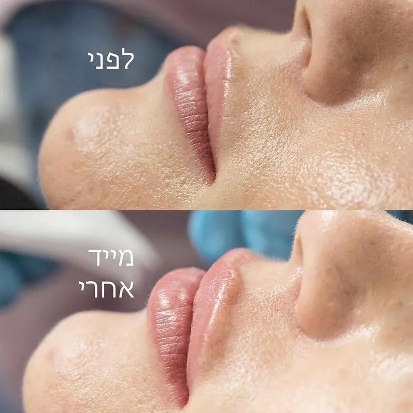 H Clinic מרפאת מומחים - עיצוב שפתיים בחומצה היאלורונית