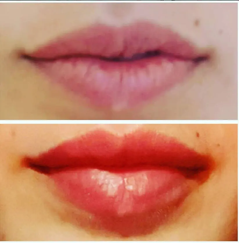 פרופ' ליאור הלר - עיצוב שפתיים בחומצה היאלורונית