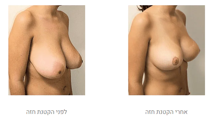 ד&quot;ר דן רגב - פיסול האף בחומרי מילוי