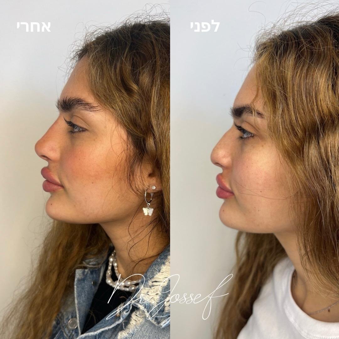 ד"ר יאיר יוסף - רפואה אסתטית מתקדמת - פיסול אף ללא ניתוח