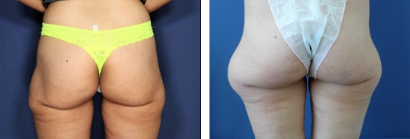 ד"ר רונן גלזינגר - ניתוח שאיבת שומן - שאיבת שומן מהירכיים לפני ואחרי