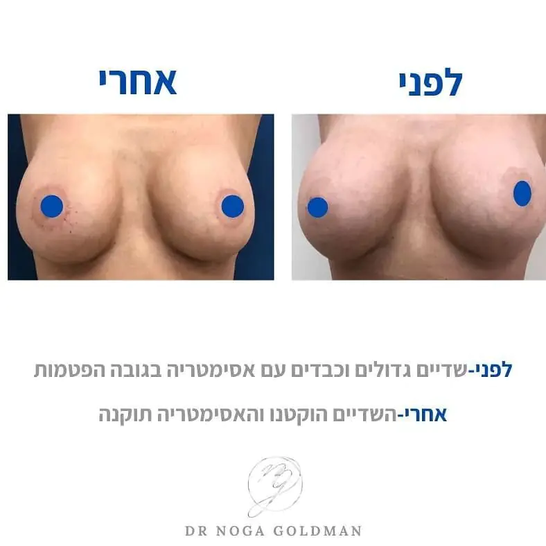 ד״ר נגה גולדמן - הגדלת חזה ע&quot;י שתל סיליקון