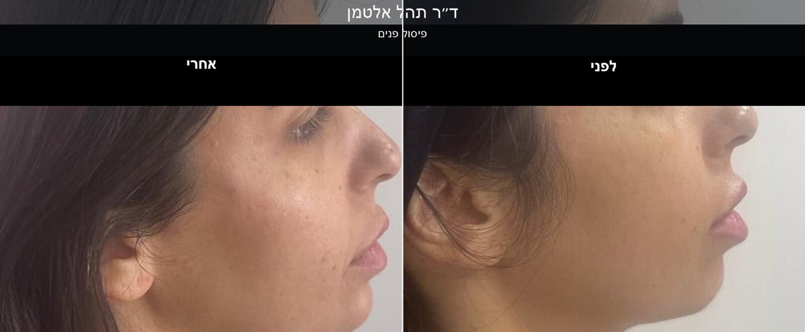 ד״ר תהל אלטמן - פיסול פנים במראה טבעי ד״ר תהל אלטמן - פיסול פנים במראה טבעי