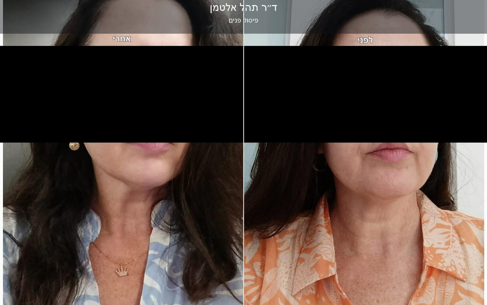 ד״ר תהל אלטמן - פיסול פנים במראה טבעי ד״ר תהל אלטמן - פיסול פנים במראה טבעי