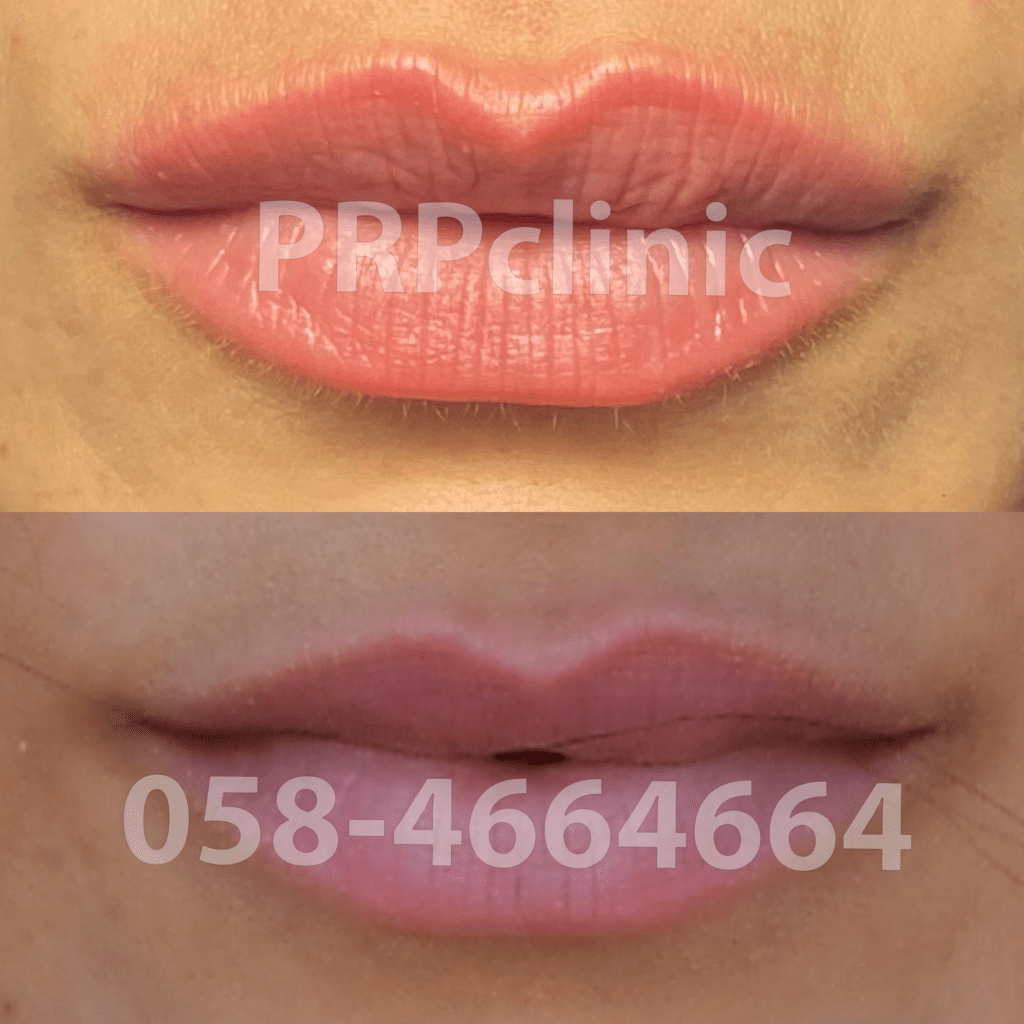 PRP Clinic - עיצוב שפתיים בחומצה היאלורונית