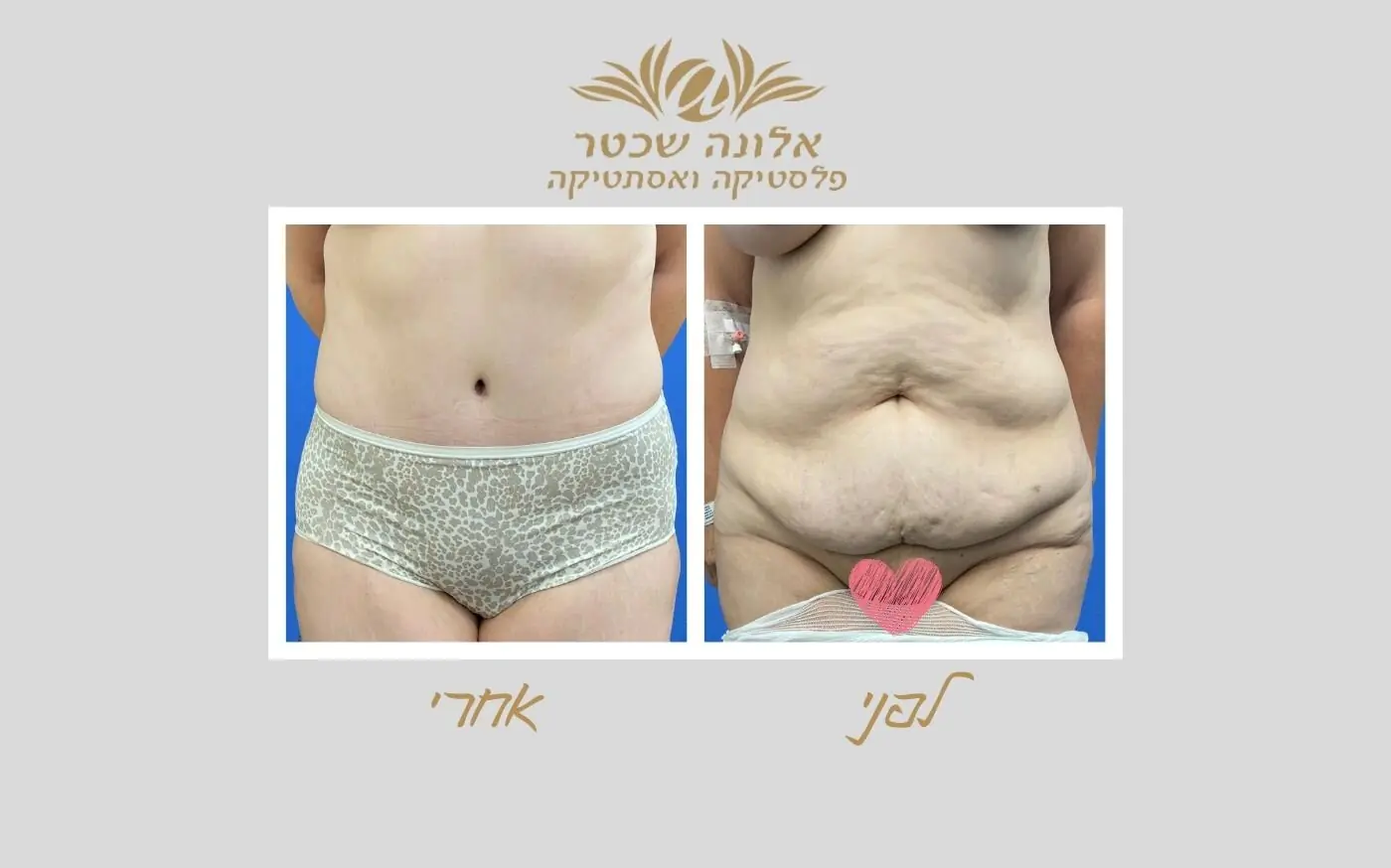 אלונה שכטר אסתטיקה - טיפול בקמטים בבוטוקס