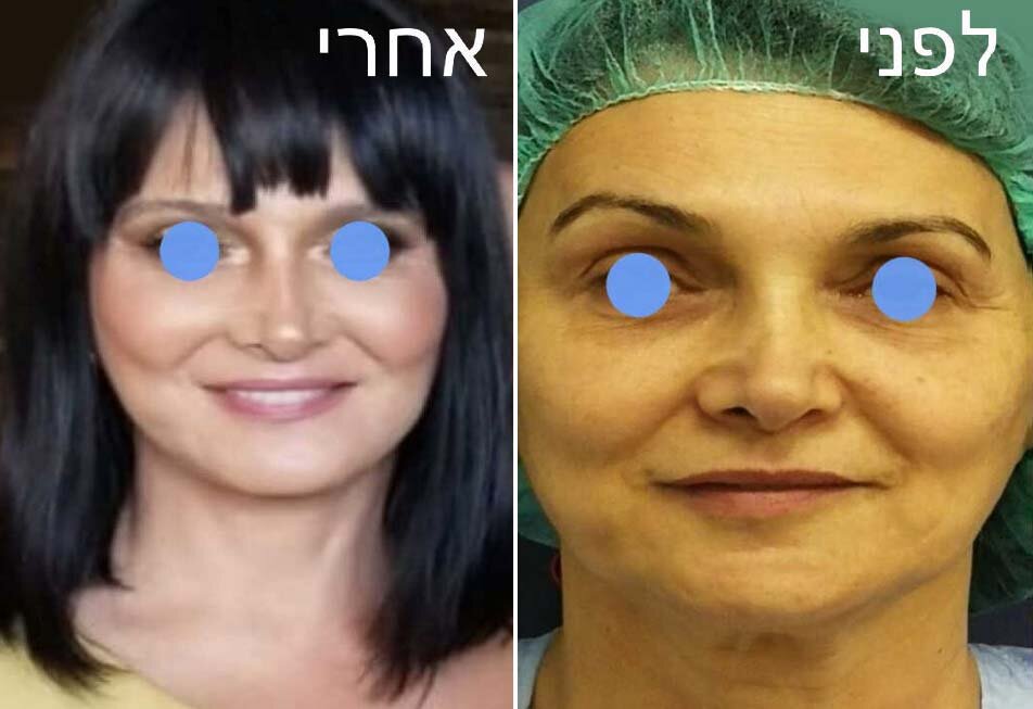 ד&quot;ר אייל שפירא - ניתוח מתיחת פנים