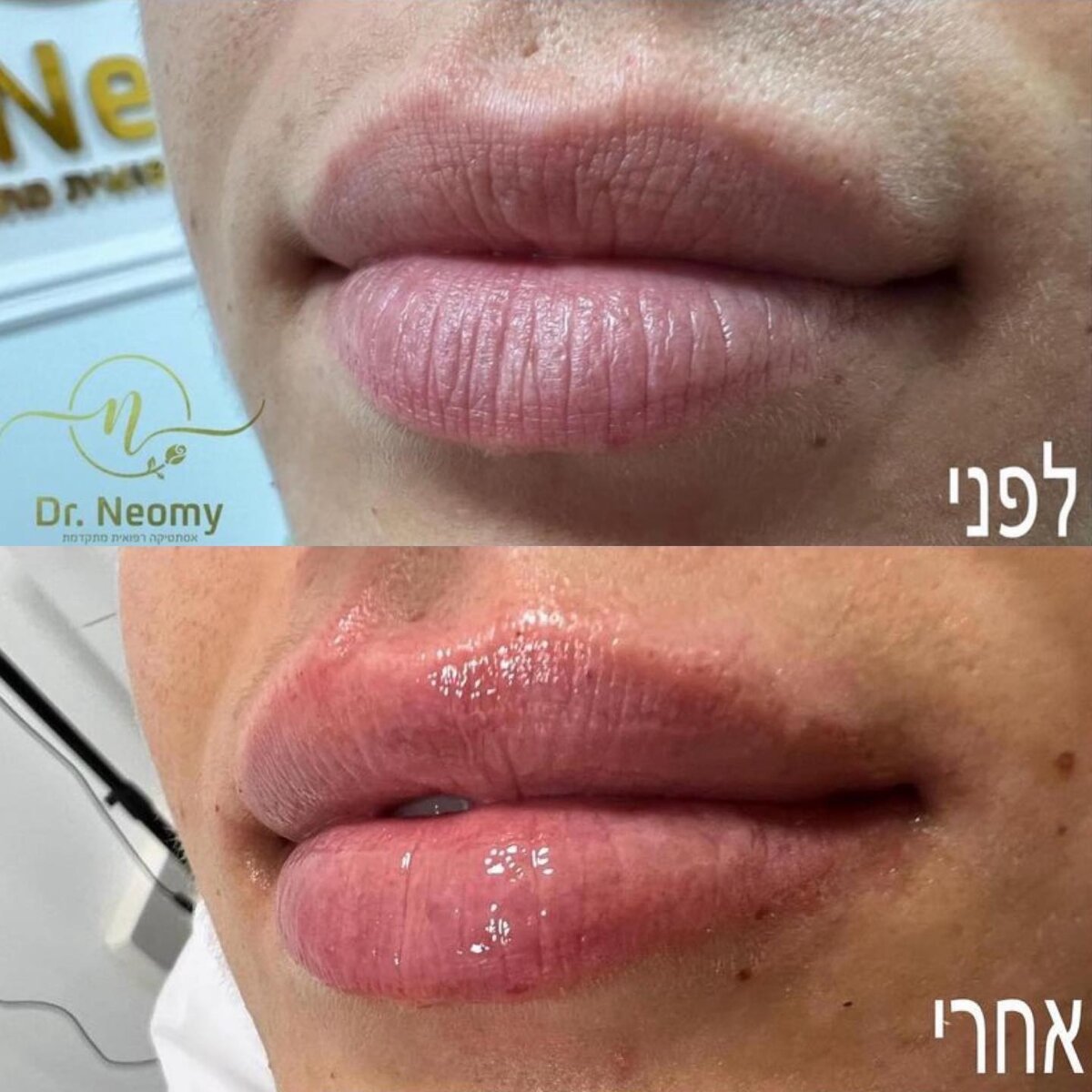 ד"ר נעמי איצקוביץ - עיצוב שפתיים בחומצה היאלורונית