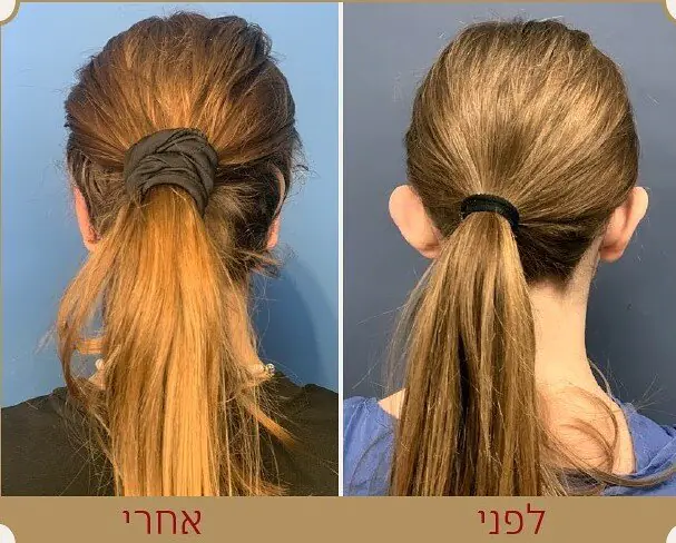 אלונה שכטר אסתטיקה - פיסול האף בחומרי מילוי