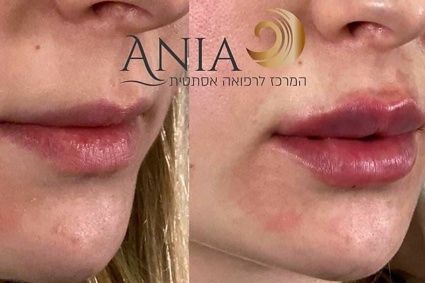 אניה בלוך - מרכז לרפואה אסתטית - עיצוב שפתיים בחומצה היאלורונית