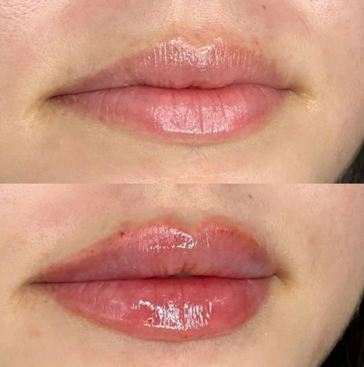 נטורלוק - עיצוב שפתיים בחומצה היאלורונית