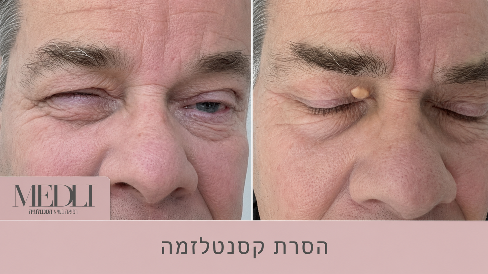 מרפאת מדלי - הסרת נגעים מכל הסוגים מרפאת מדלי - הסרת נגעים מכל הסוגים