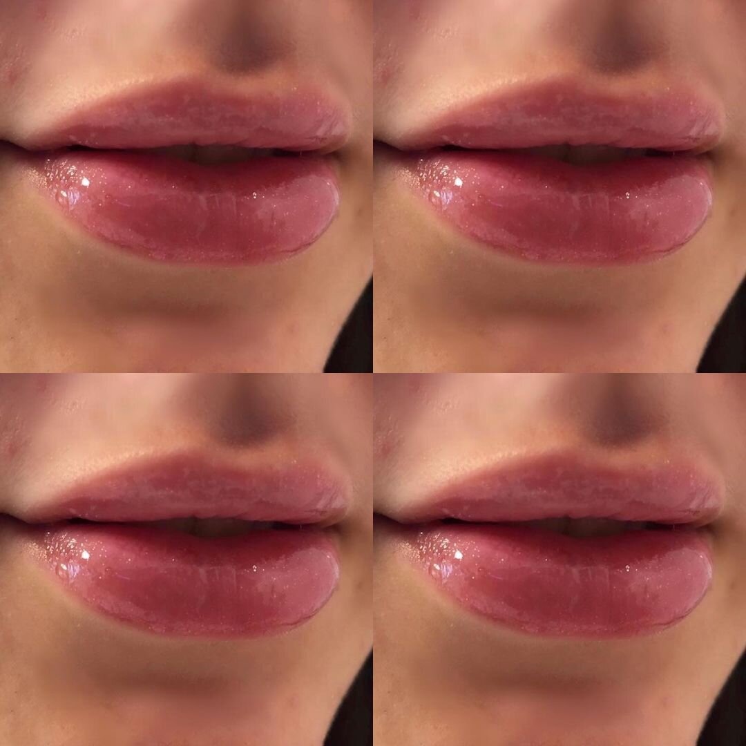ד"ר אהרון עמיר - עיבוי שפתיים בחומצה היאלורונית