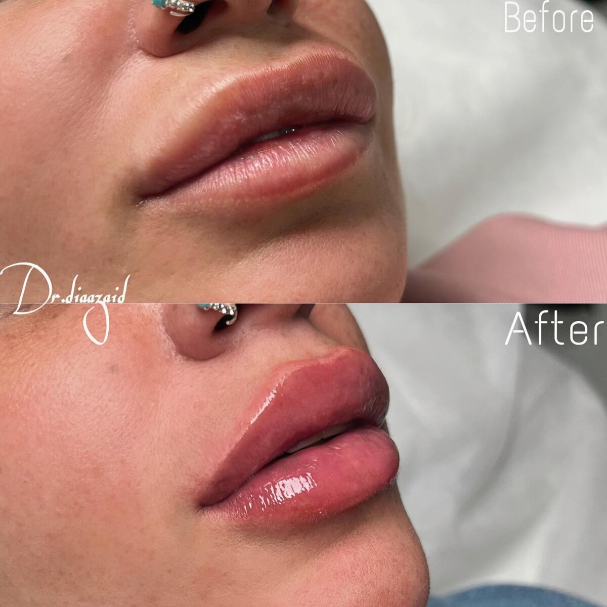 Diaa Zaid - עיצוב שפתיים