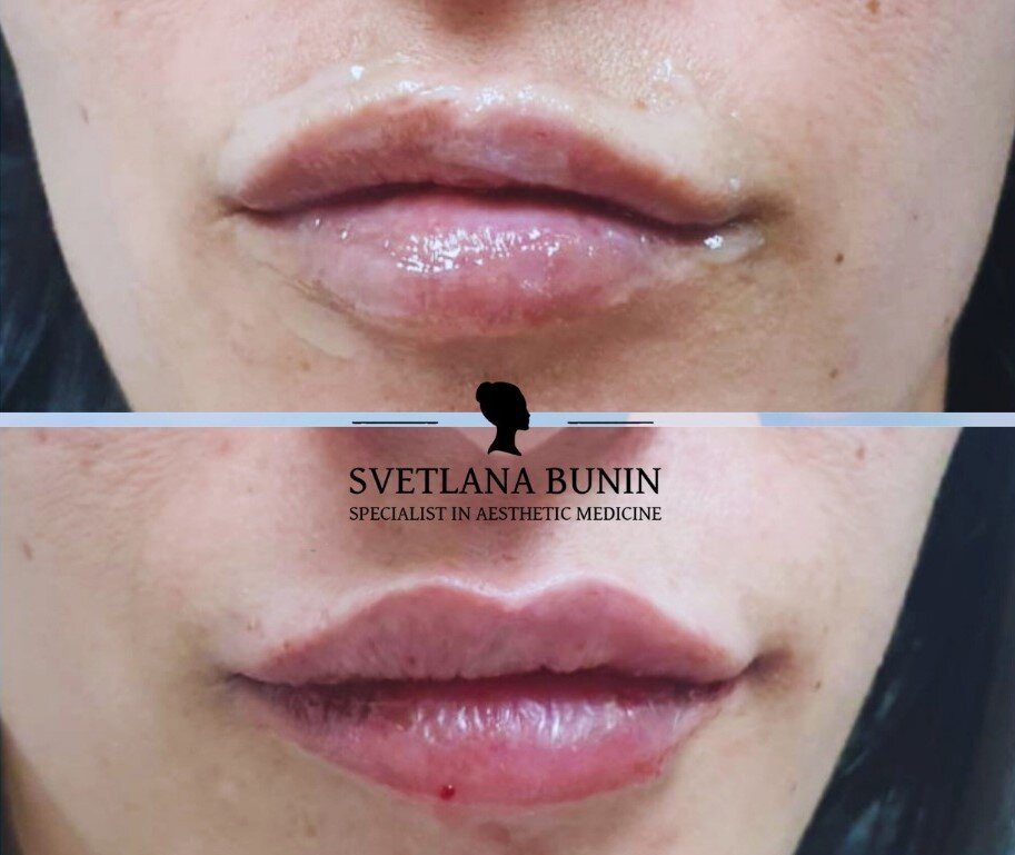 ד"ר סבטלנה בונין - עיצוב שפתיים בחומצה היאלורונית