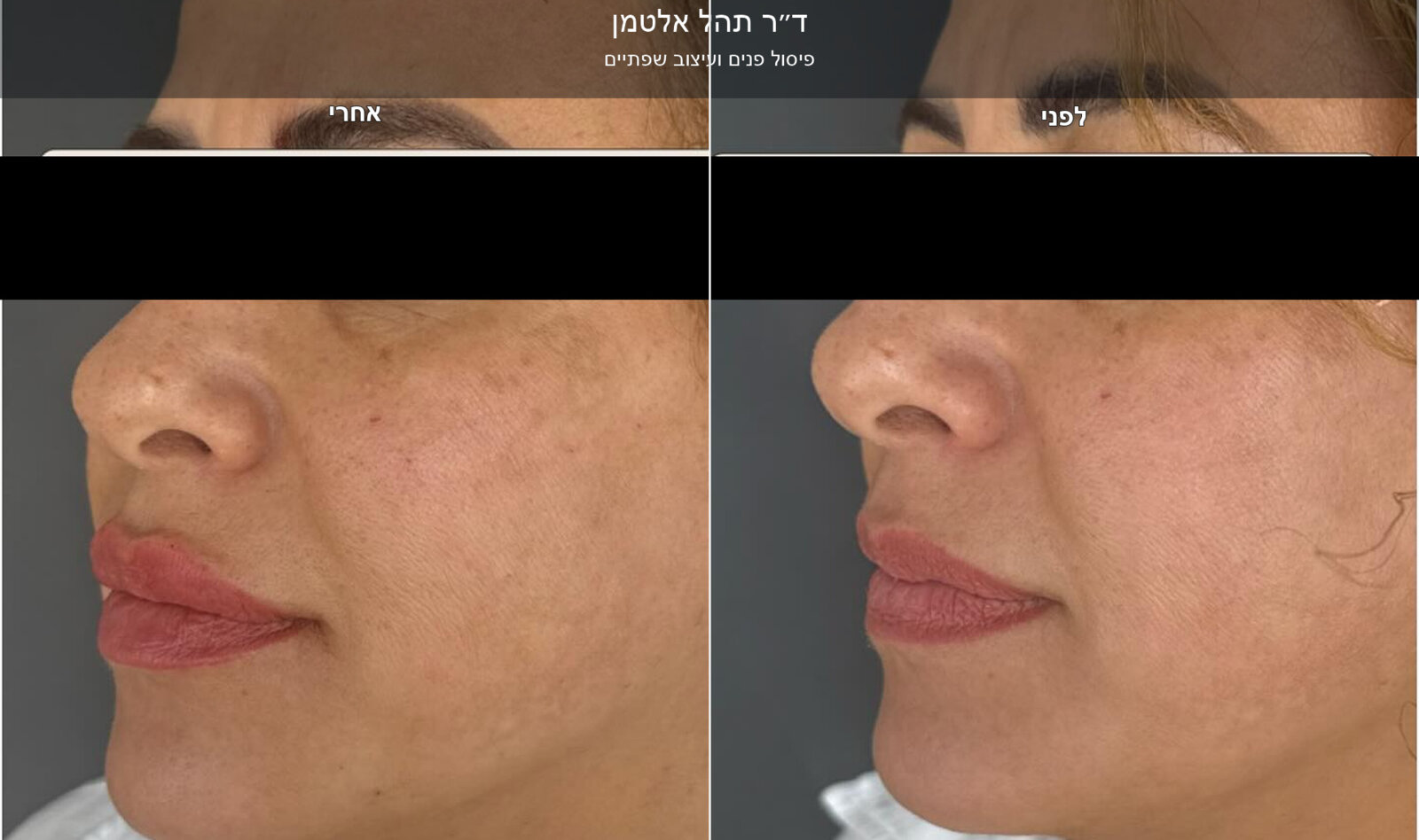 ד״ר תהל אלטמן - פיסול פנים במראה טבעי ד״ר תהל אלטמן - פיסול פנים במראה טבעי