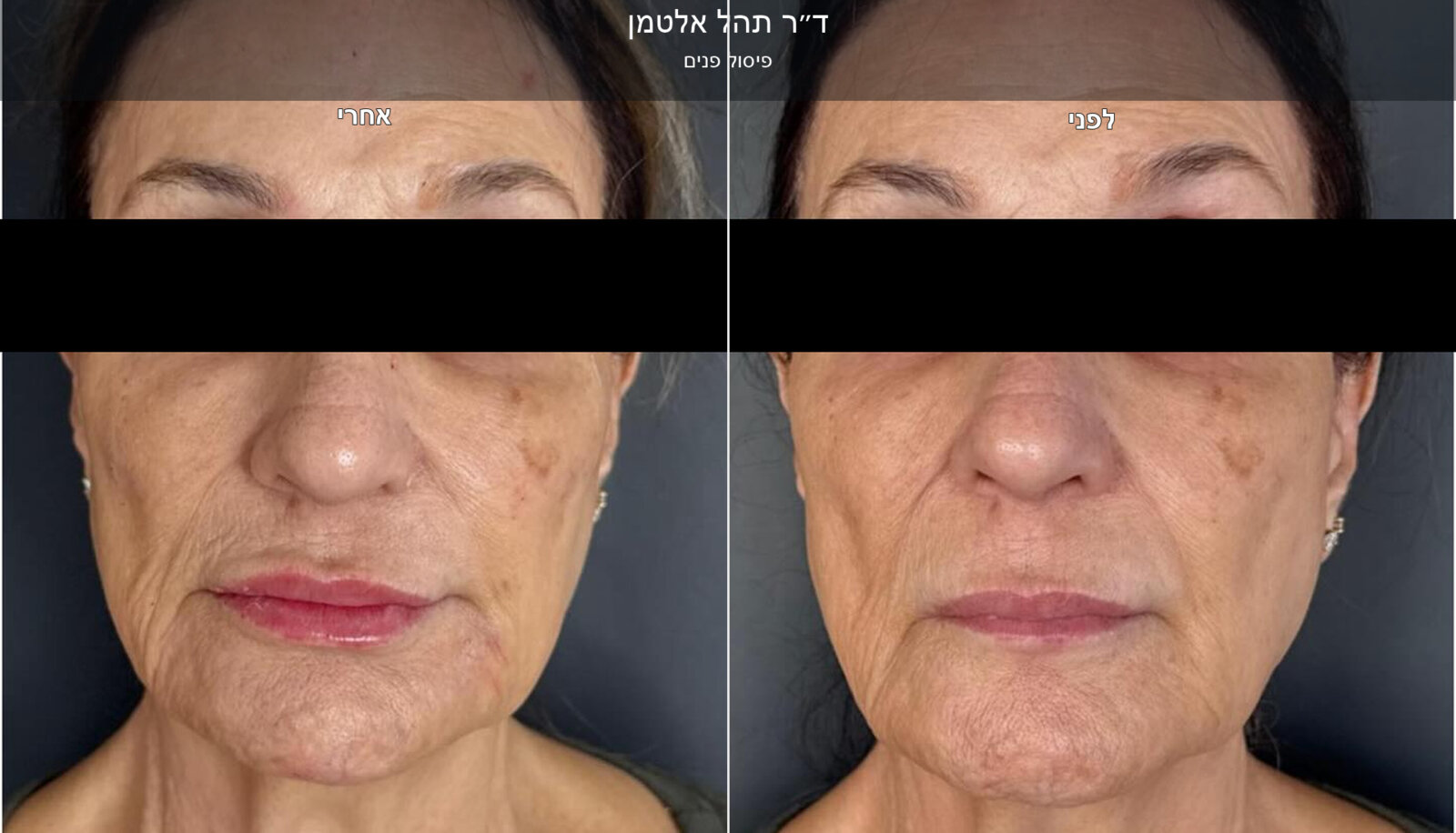 ד״ר תהל אלטמן - פיסול פנים במראה טבעי ד״ר תהל אלטמן - פיסול פנים במראה טבעי