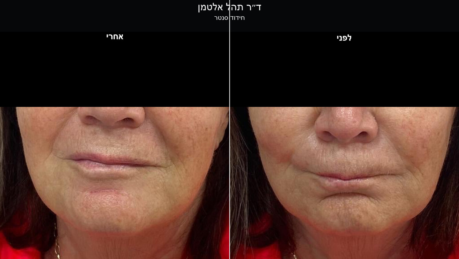 ד״ר תהל אלטמן - פיסול פנים במראה טבעי ד״ר תהל אלטמן - פיסול פנים במראה טבעי
