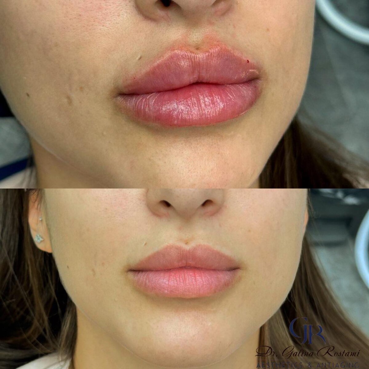 ד"ר גלינה רוסטמי - עיצוב שפתיים בחומצה היאלורונית