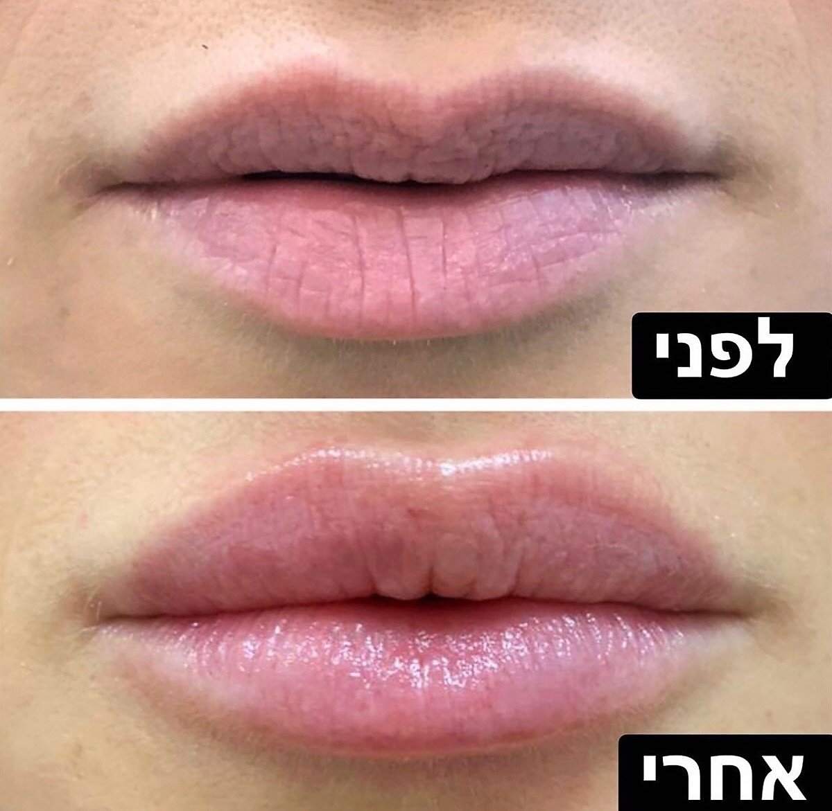וולנס Wellness - עיצוב שפתיים בחומצה היאלורונית