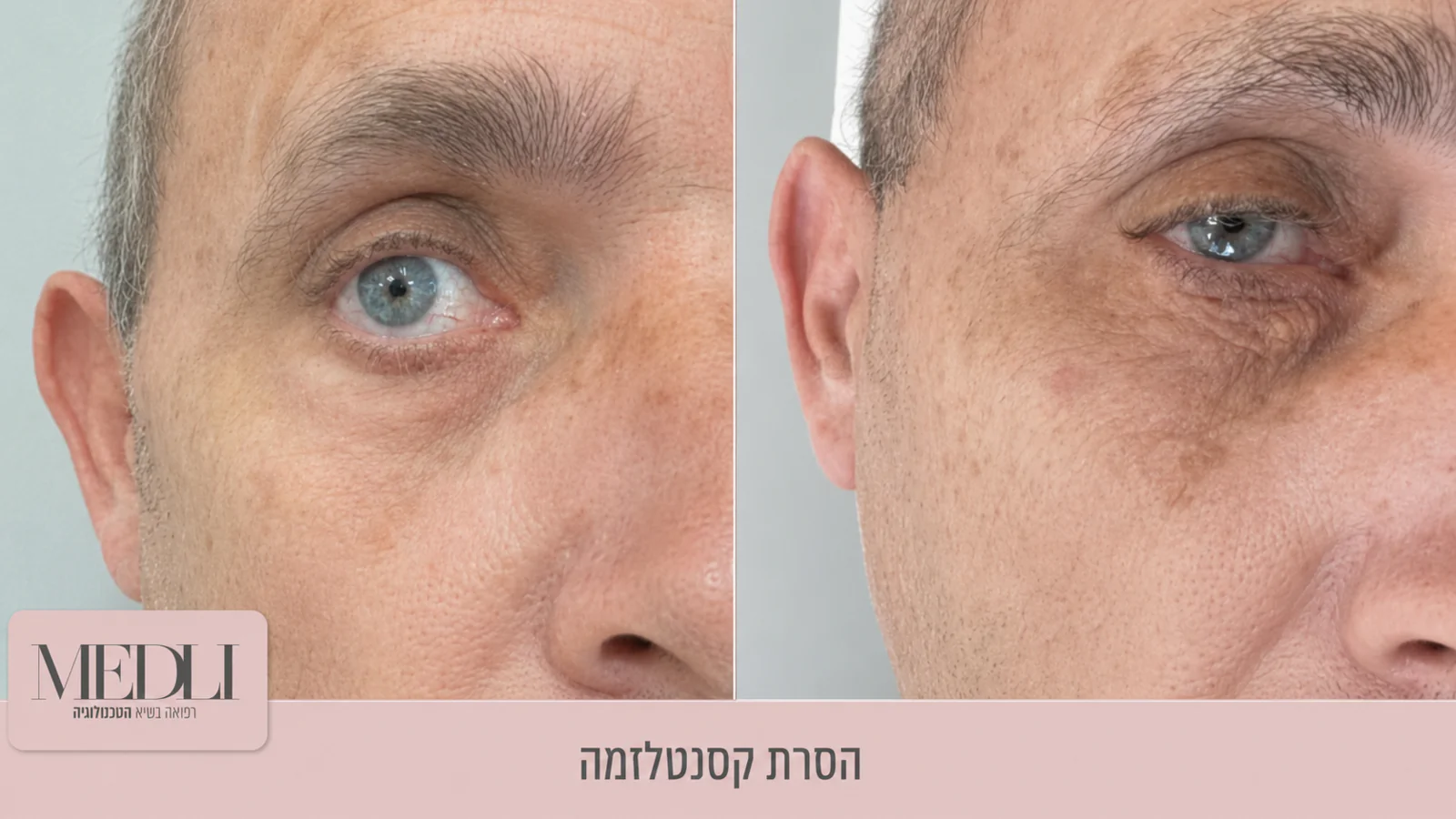 מרפאת מדלי - הסרת נגעים מכל הסוגים מרפאת מדלי - הסרת נגעים מכל הסוגים