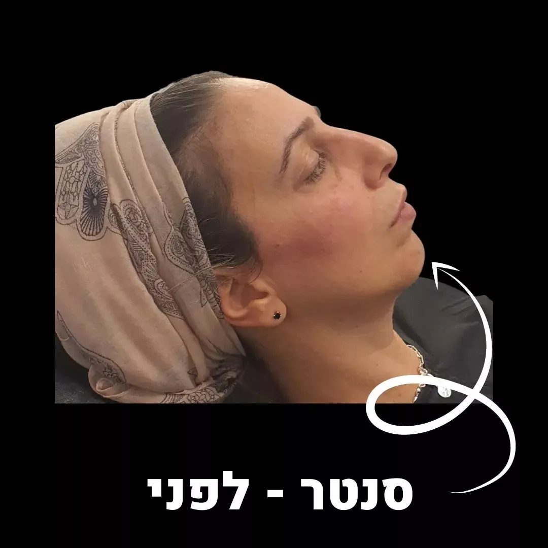  ד''ר טל - עיצוב שפתיים בחומצה היאלורונית