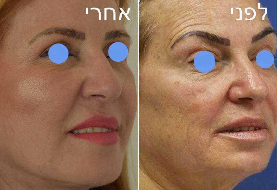 ד&quot;ר אייל שפירא - ניתוח מתיחת פנים