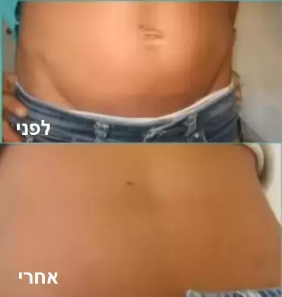 ד&quot;ר יאיר גילוני - העלמת סימני מתיחה בפילינג