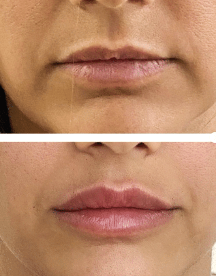 PRP Clinic - עיצוב שפתיים בחומצה היאלורונית