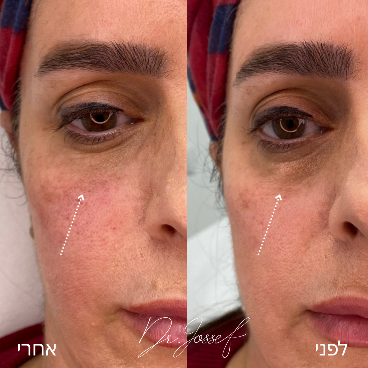 ד"ר יאיר יוסף - רפואה אסתטית מתקדמת - מילוי שקעי עיניים