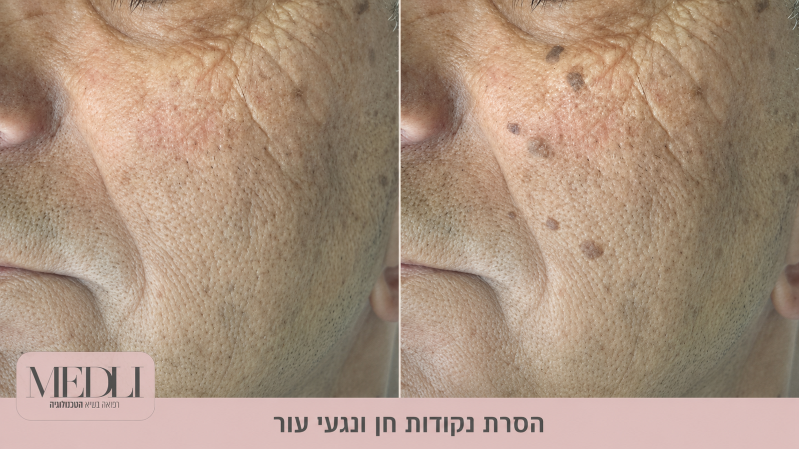 מרפאת מדלי - הסרת נגעים מכל הסוגים מרפאת מדלי - הסרת נגעים מכל הסוגים