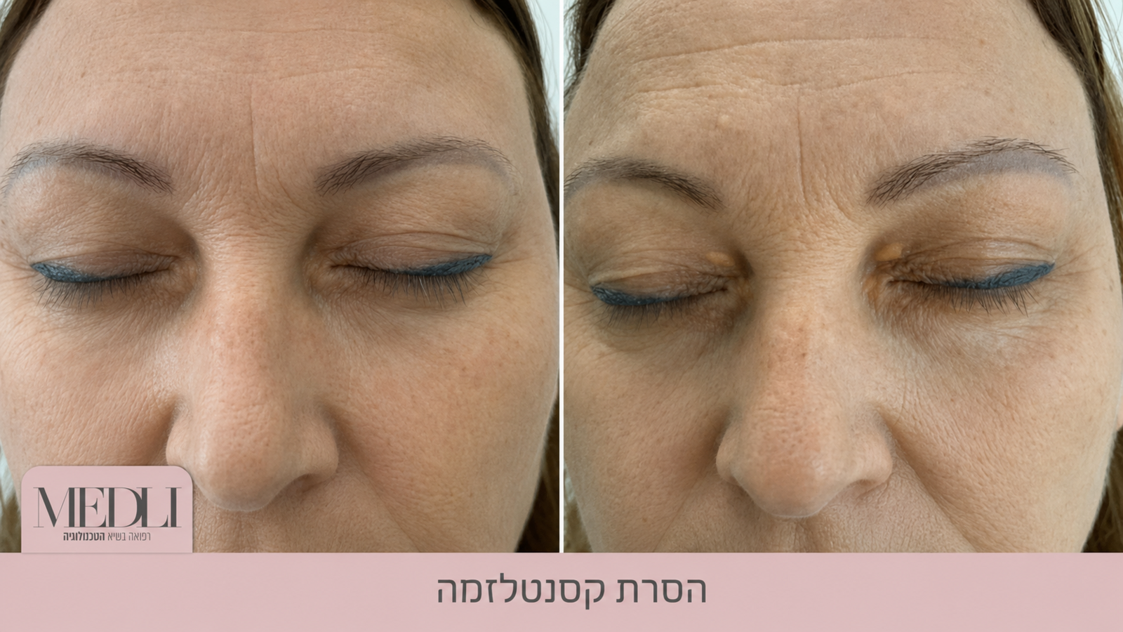 מרפאת מדלי - הסרת נגעים מכל הסוגים מרפאת מדלי - הסרת נגעים מכל הסוגים