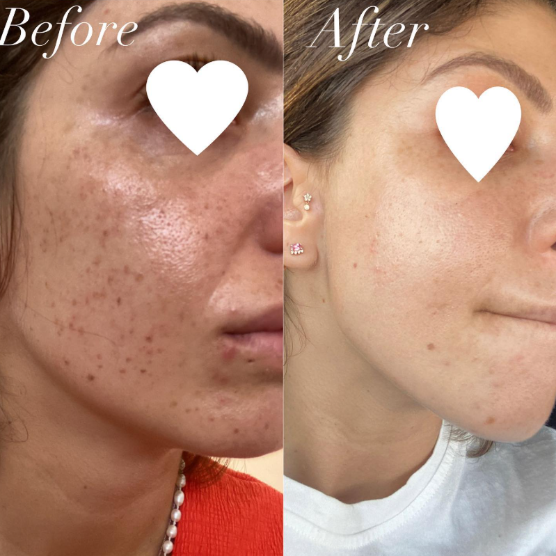 Kayla Daniel - טיפול בפיגמנטציה בלייזר Kayla Daniel - טיפול בפיגמנטציה בלייזר