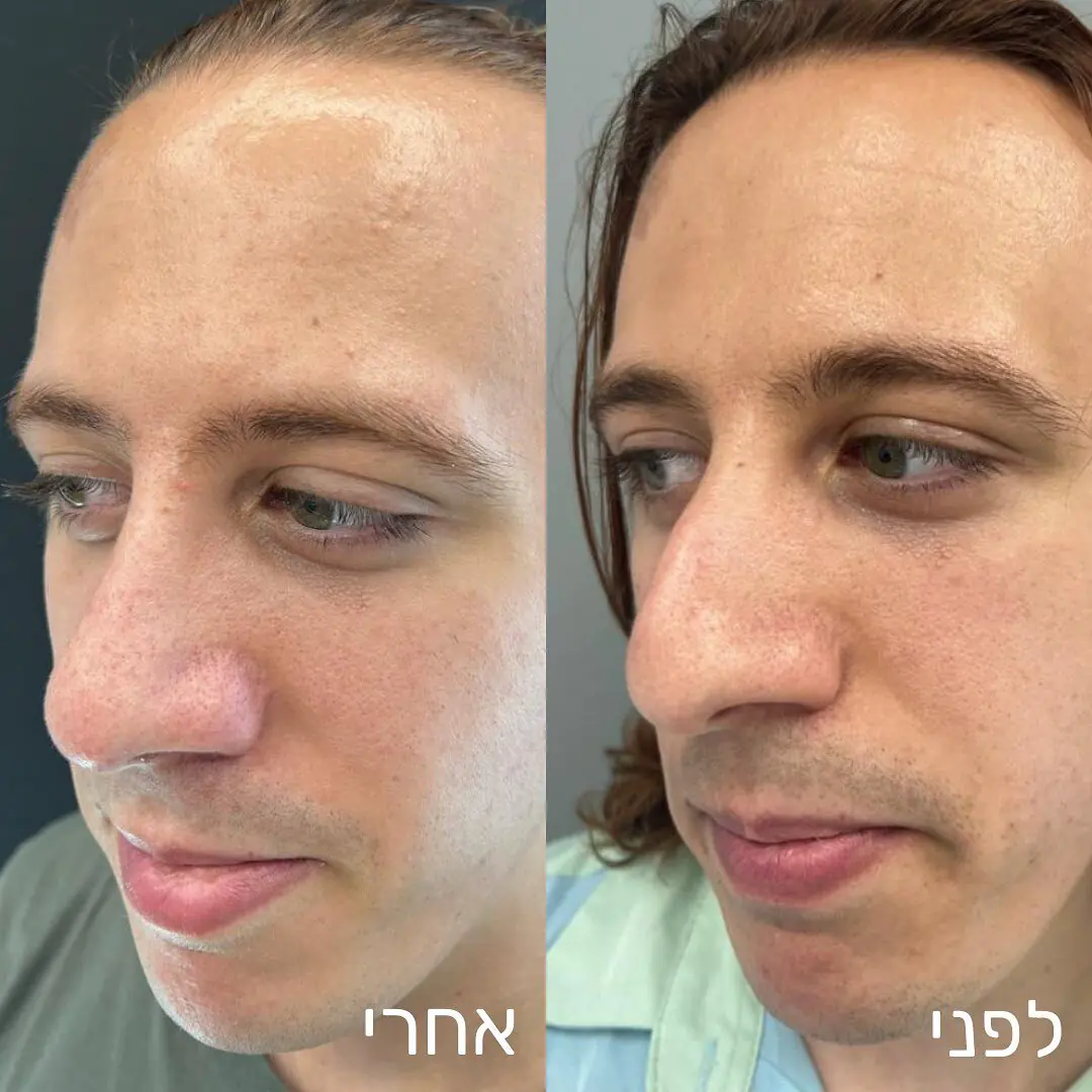 ניתוח לעיצוב האף ניתוח לעיצוב האף