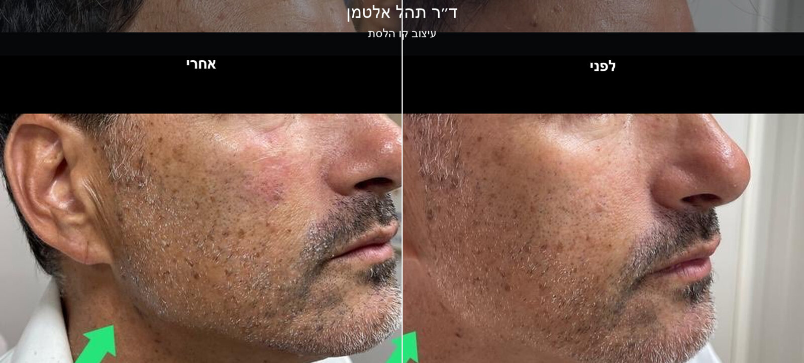 ד״ר תהל אלטמן - פיסול פנים במראה טבעי ד״ר תהל אלטמן - פיסול פנים במראה טבעי