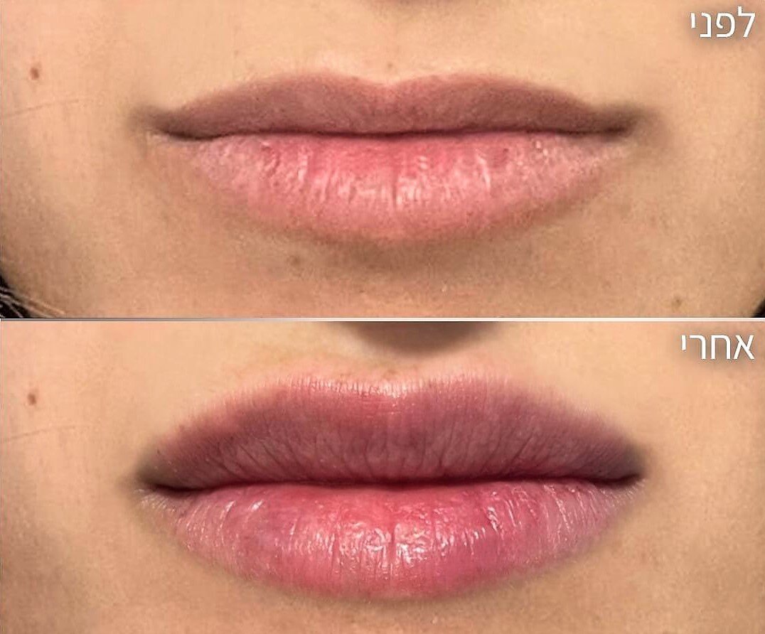 ד"ר ניר ביטרמן - עיצוב שפתיים בחומצה היאלורונית