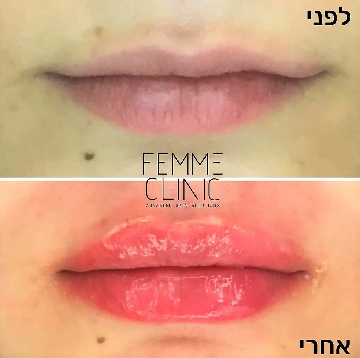 פאם קליניק - עיצוב שפתיים בחומצה היאלורונית