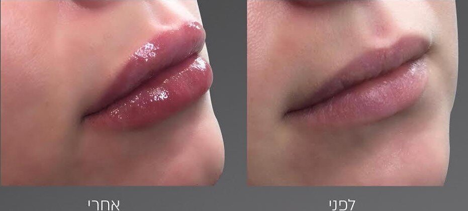 ד"ר אהרון עמיר - עיבוי שפתיים בחומצה היאלורונית