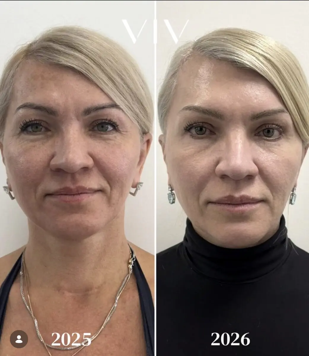 מרכז רפואי VIV - פיסול לחיים בהזרקות