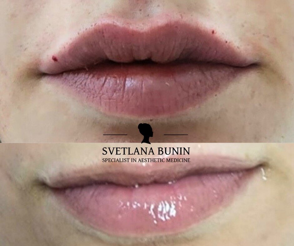 ד&quot;ר סבטלנה בונין - עיצוב שפתיים בחומצה היאלורונית