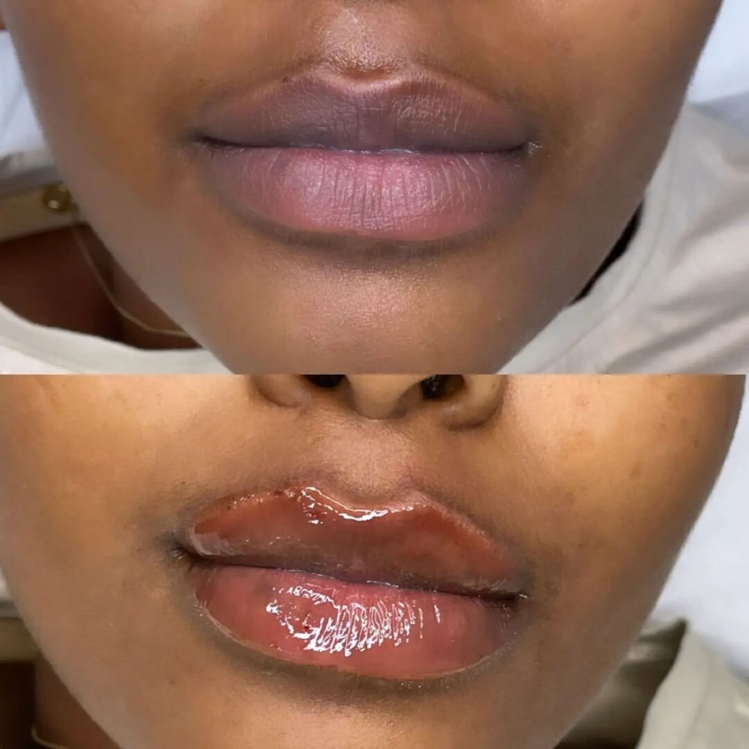 ד"ר מורן להב - עיצוב שפתיים בחומצה היאלורונית