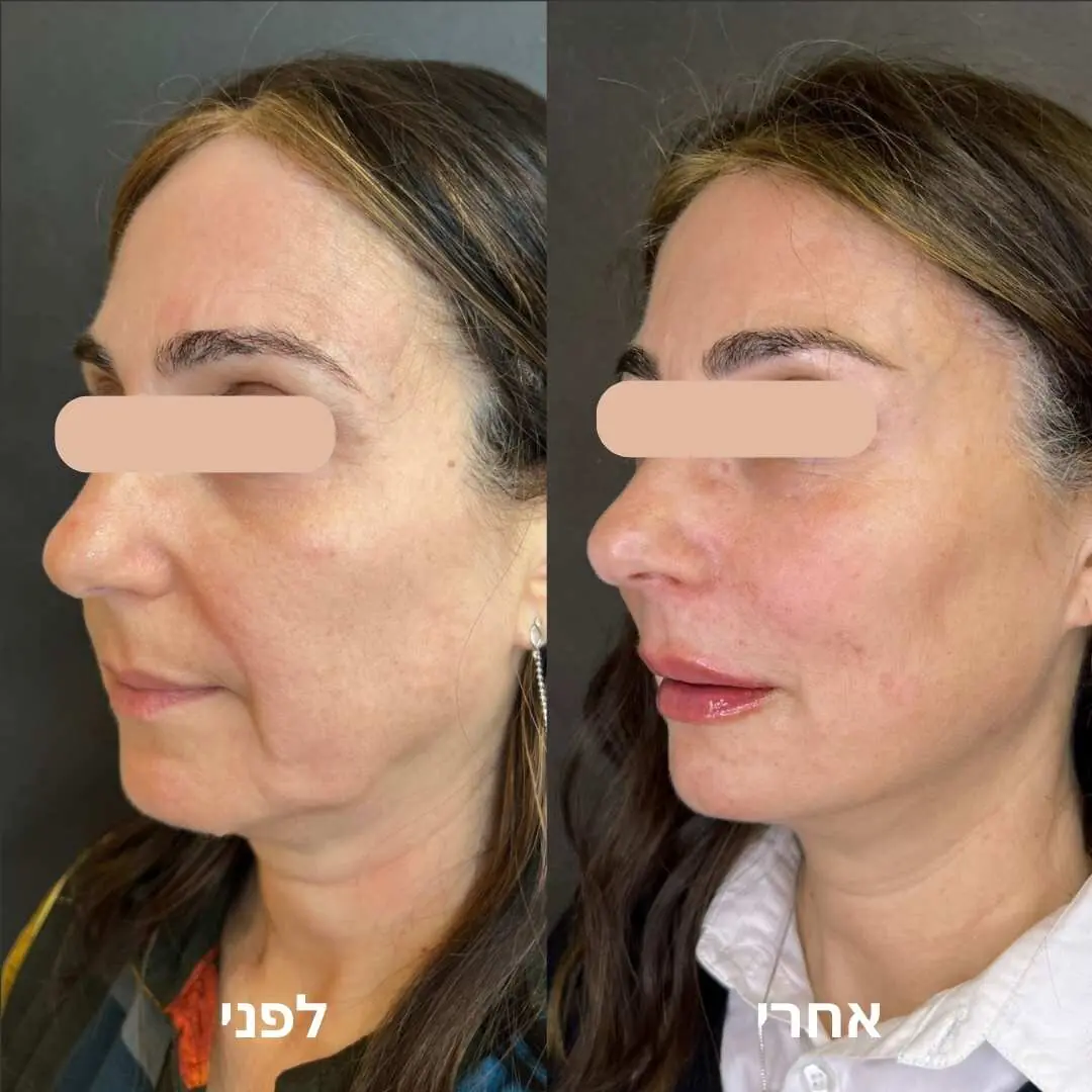 ד&quot;ר משה רוזן - העלמה וטשטוש צלקות אקנה