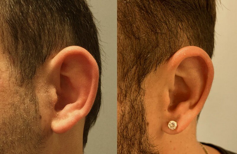 ד&quot;ר ערן חדד - ניתוח להצמדת אוזניים