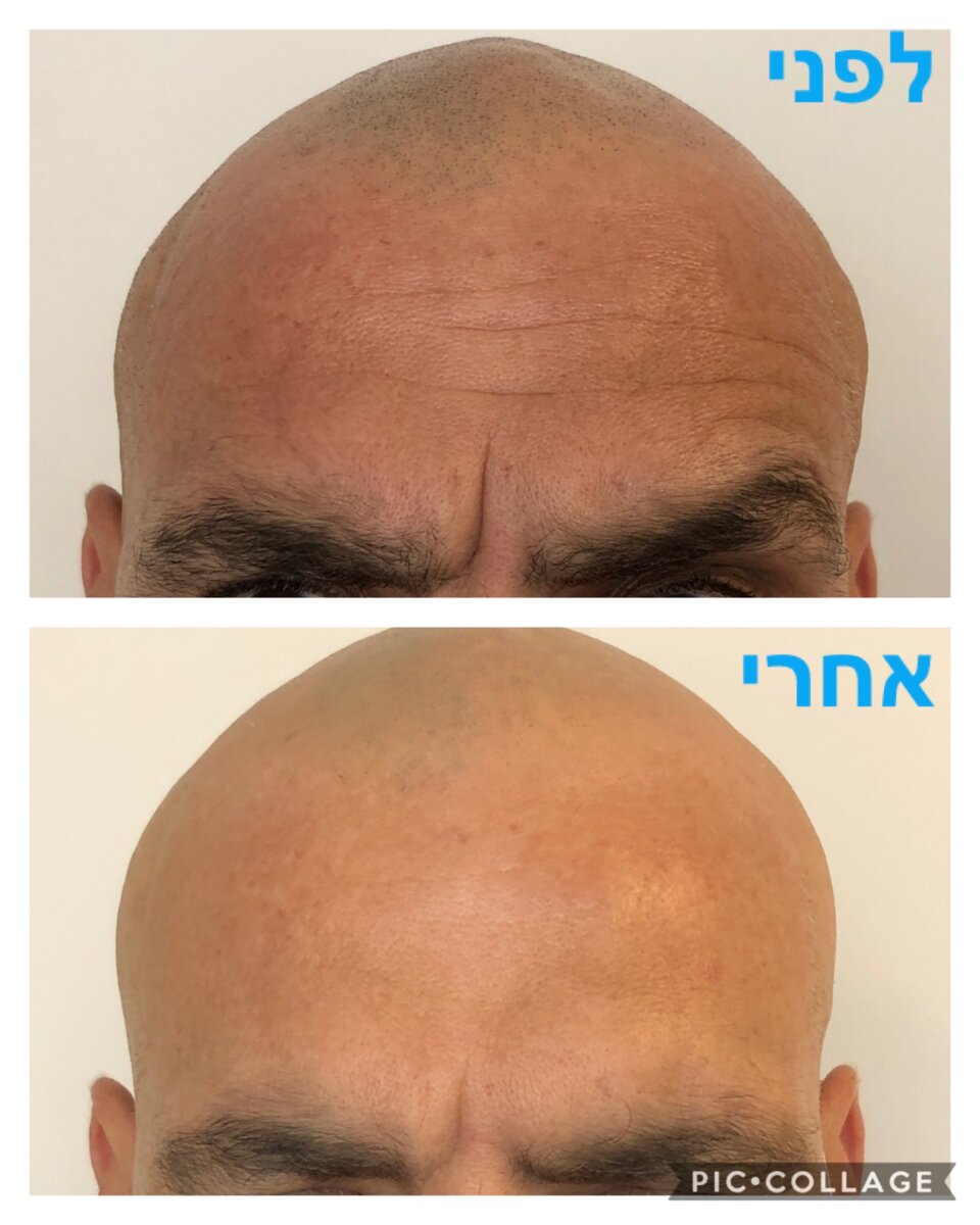 ד״ר נגה גולדמן - טיפול בקמטים בבוטוקס