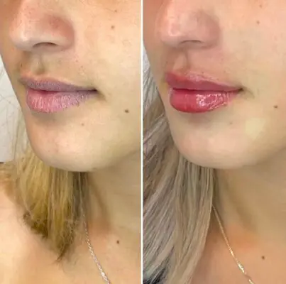 ד"ר אורי ברגר - עיצוב שפתיים בחומצה היאלורונית