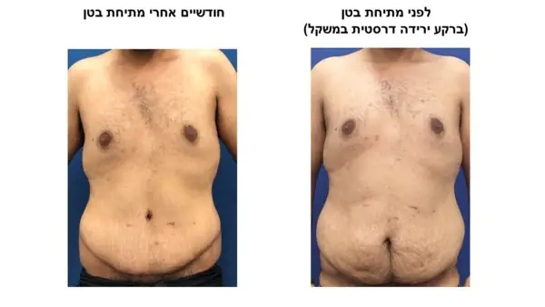 ד״ר תמיר גיל - עיצוב הגוף לאחר ירידה דרסטית במשקל