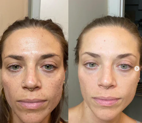 Kayla  Daniel - טיפול בפיגמנטציה בלייזר